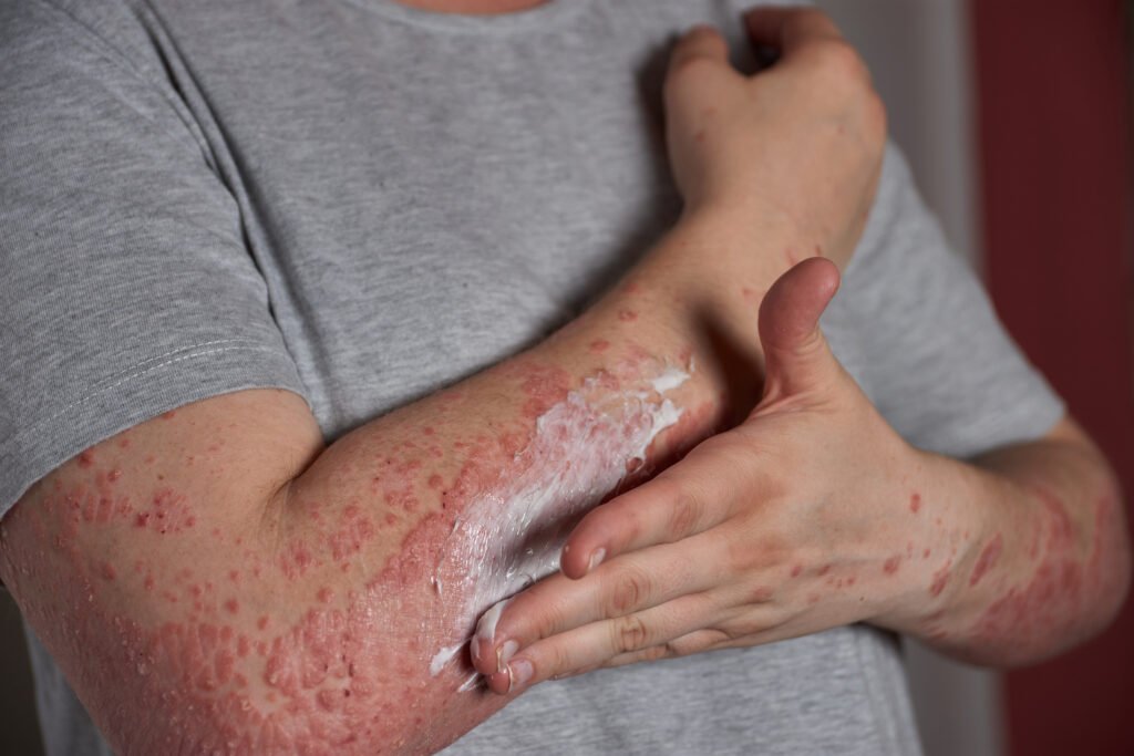 Treatment and Management of Viral Rash Infections