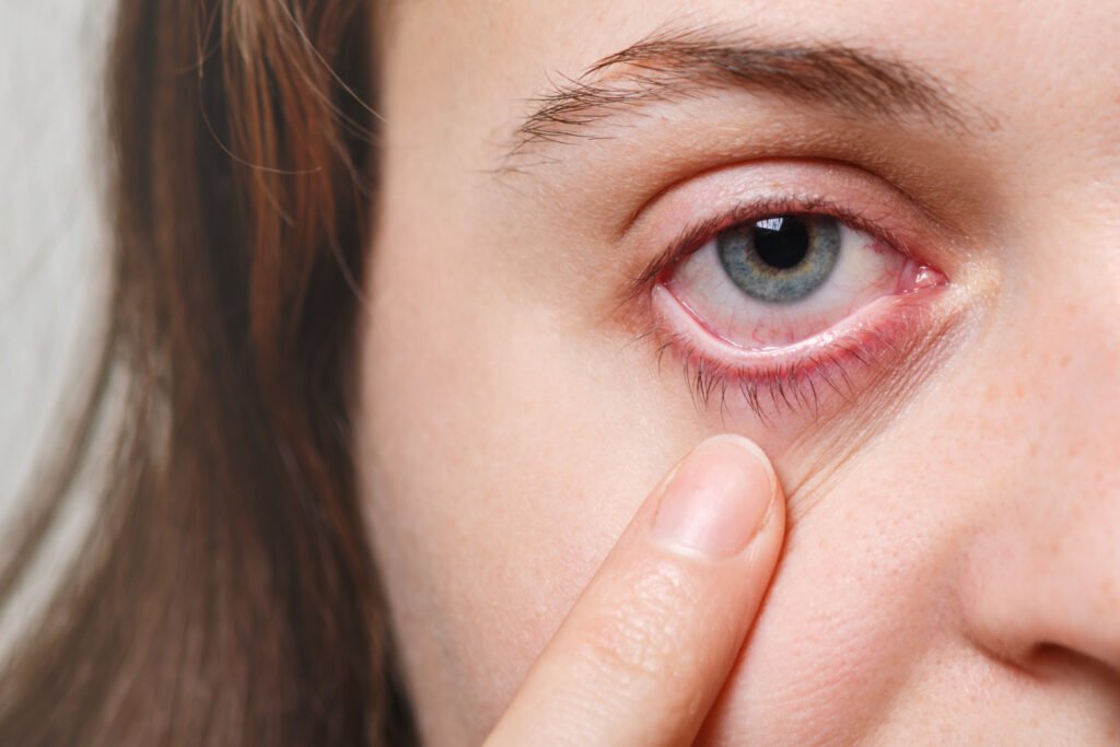Eye Symptoms