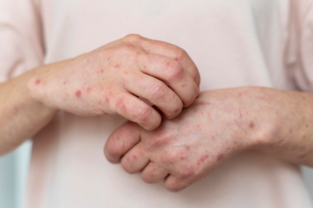 Common Viral Rash Infections