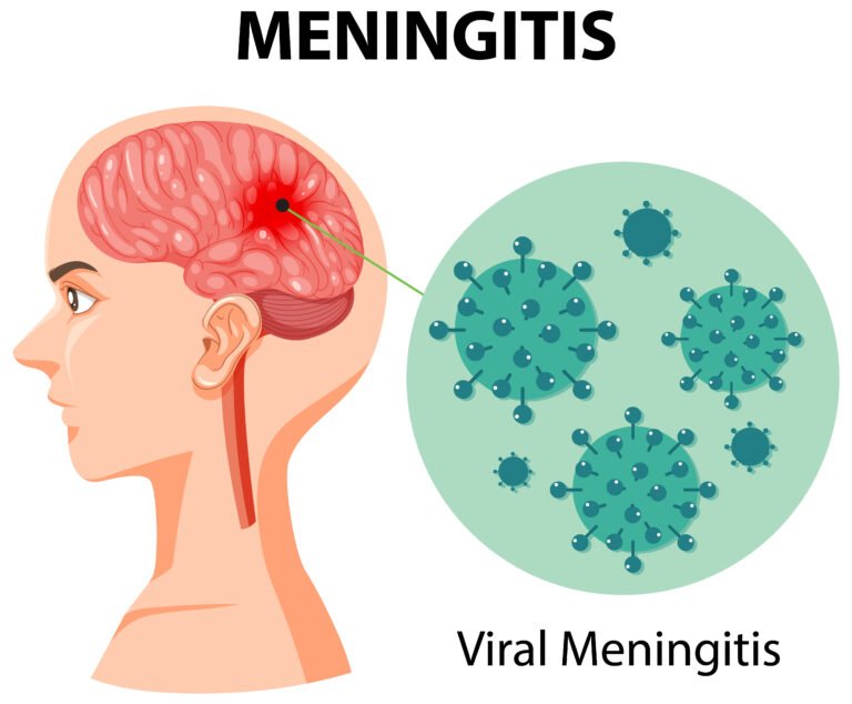 Meningitis: Is Meningitis a Critical Medical Situation?