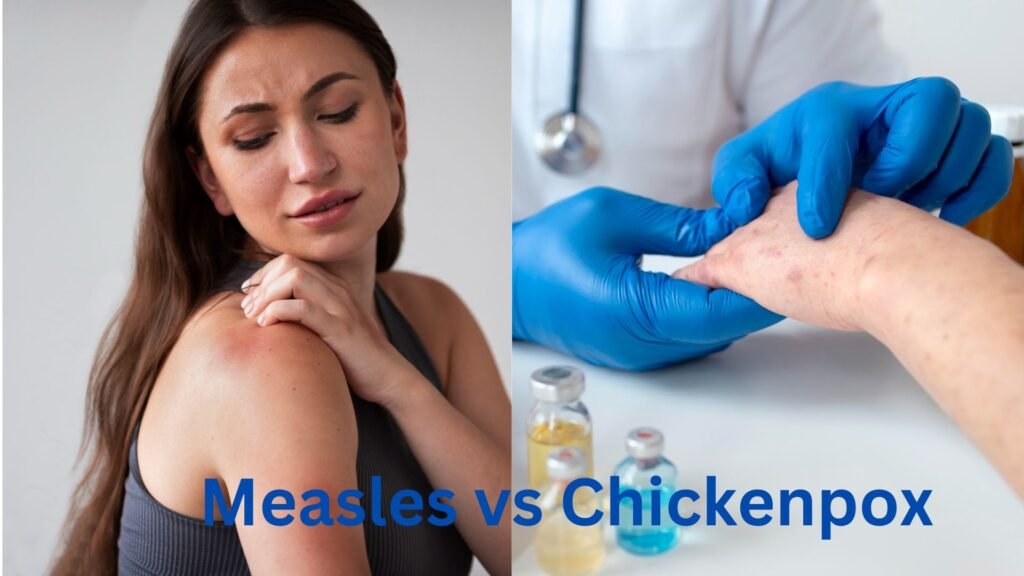 Measles vs Chickenpox