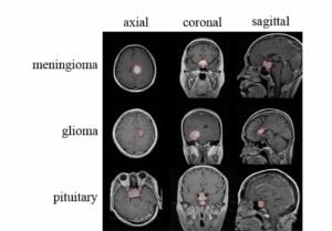 Types of Brain Tumors