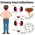 Urinary Tract Infections: Decoding Hidden Risks & Prevention