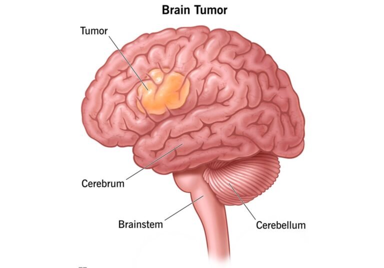 Brain Tumors: Innovations in Diagnosis and TreatmenT